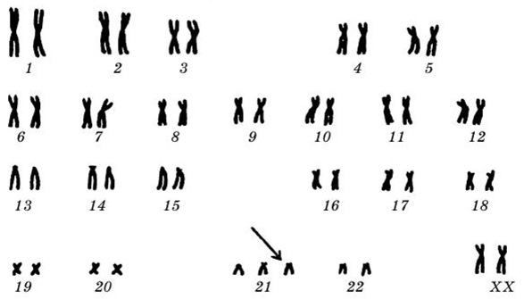 Синдром Дауна. Фото взрослых, детей, кариотип, причины, симптомы, признаки, лечение, диагностика, риск