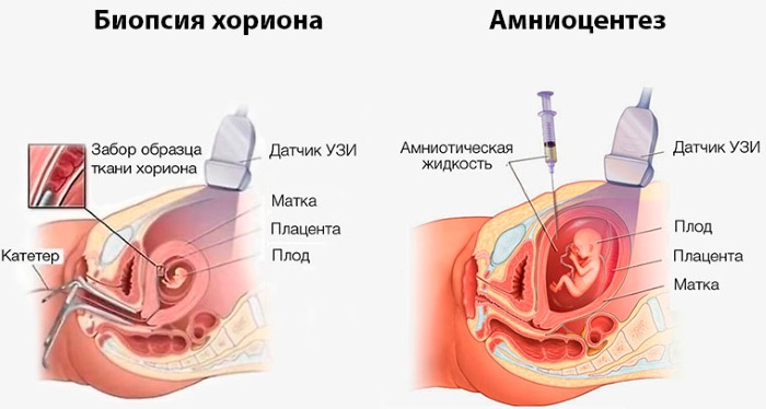 Синдром Дауна. Фото взрослых, детей, кариотип, причины, симптомы, признаки, лечение, диагностика, риск