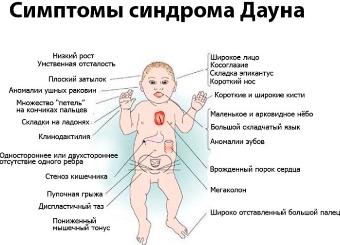 Синдром Дауна. Фото взрослых, детей, кариотип, причины, симптомы, признаки, лечение, диагностика, риск