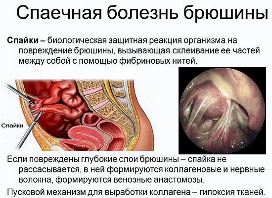 Тело матки в anteflexio versio. Что это, норма у взрослого, беременных