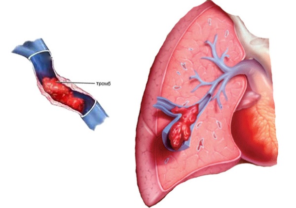 Тромбоэмболия легочной артерии. Симптомы, признаки, диагностика, лечение