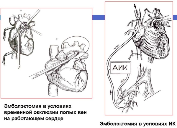 Тромбоэмболия легочной артерии. Симптомы, признаки, диагностика, лечение