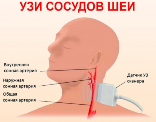 УЗДГ брахиоцефальных артерий. Что это такое, как делают, что показывает, подготовка, расшифровка