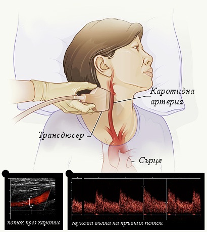 УЗДГ брахиоцефальных артерий. Что это такое, как делают, что показывает, подготовка, расшифровка