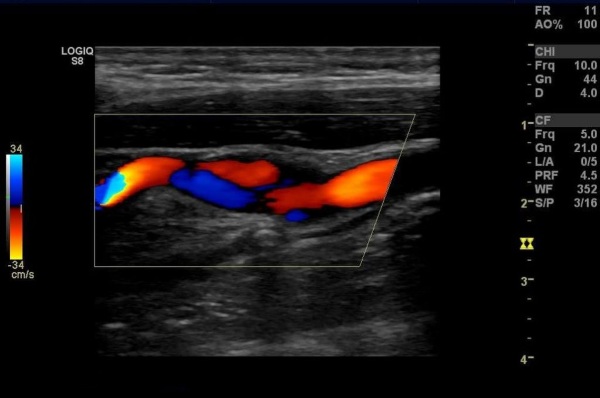 УЗДГ брахиоцефальных артерий. Что это такое, как делают, что показывает, подготовка, расшифровка
