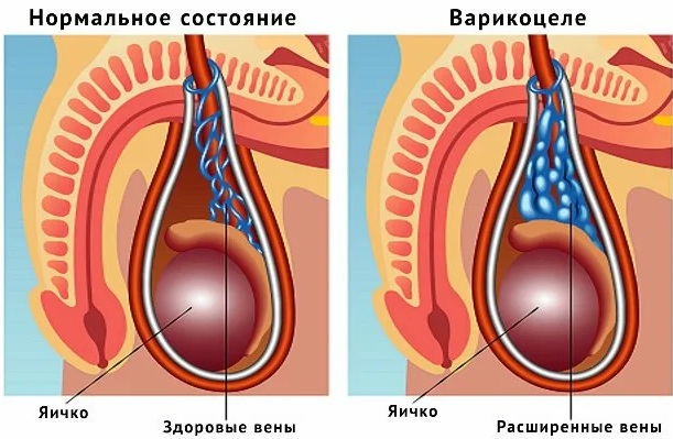 Варикоцеле. Лечение народными средствами, таблетками, степени у детей, мужчин