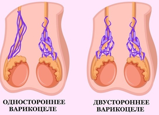 Варикоцеле. Лечение народными средствами, таблетками, степени у детей, мужчин
