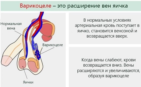 Варикоцеле. Лечение народными средствами, таблетками, степени у детей, мужчин