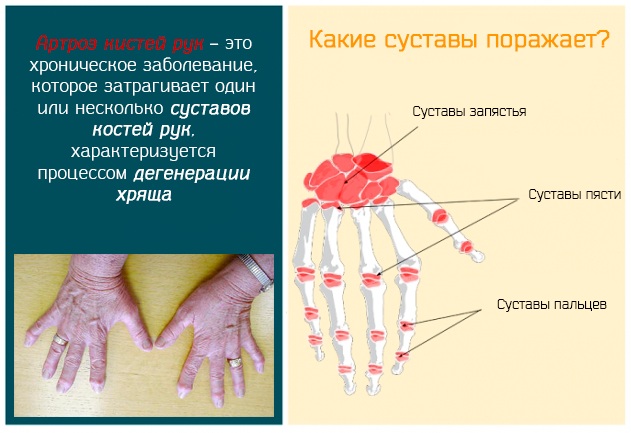 Головка лучевой кости: определение, строение, виды, выполняемые функции, анатомия, физиология, возможные заболевания и методы лечения