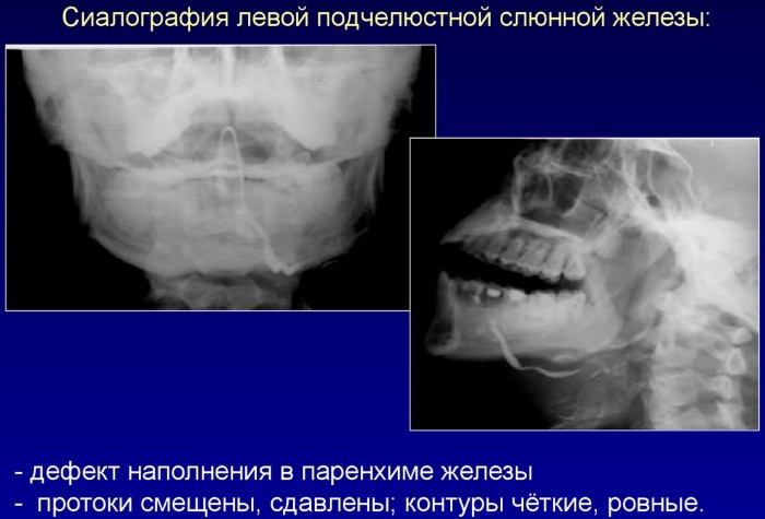 Заболевания неба во рту фото