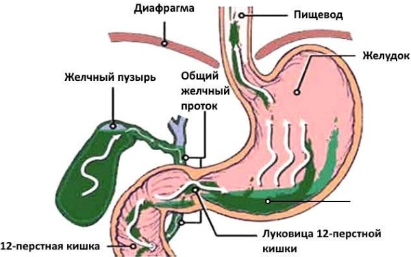 Желчь в желудке. Причины и лечение народными средствами, препараты, симптомы, диета