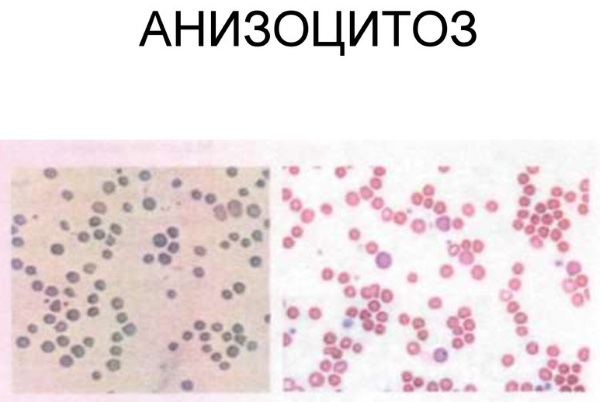 Анизоцитоз в общем анализе крови у взрослых, женщин, ребенка. Причины пониженного, повышенного