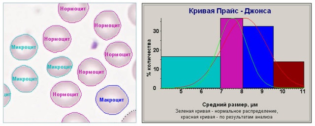 Анизоцитоз в общем анализе крови у взрослых, женщин, ребенка. Причины пониженного, повышенного