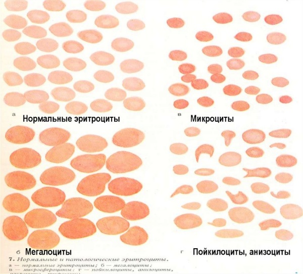 Анизоцитоз в общем анализе крови у взрослых, женщин, ребенка. Причины пониженного, повышенного