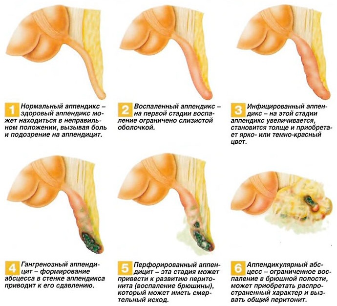 Аппендицит. Симптомы у детей 10-11-12-13 лет, с какой стороны, как определить, признаки, клинические рекомендации