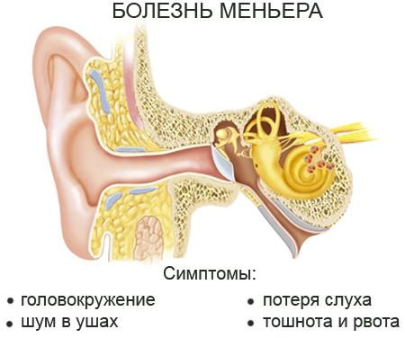 Болезнь Меньера. Что это, симптомы, диагностика, лечение народными средствами, препаратами, рекомендации