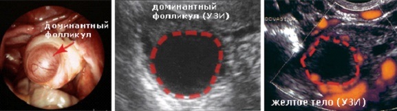 Доминантный фолликул. Что это такое, каких размеров должен быть по дням цикла, УЗИ