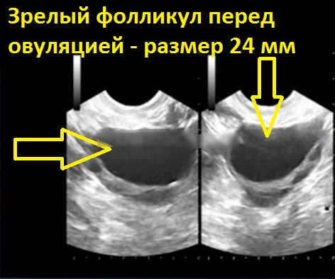 Доминантный фолликул. Что это такое, каких размеров должен быть по дням цикла, УЗИ