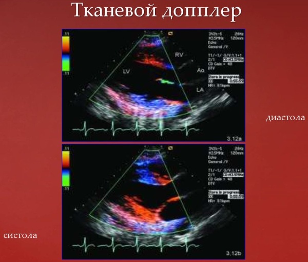 ЭХО (эхокардиография) сердца. Что показывает, нормальные показатели, как делают