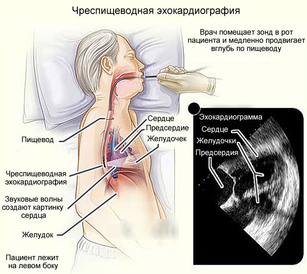 ЭХО (эхокардиография) сердца. Что показывает, нормальные показатели, как делают