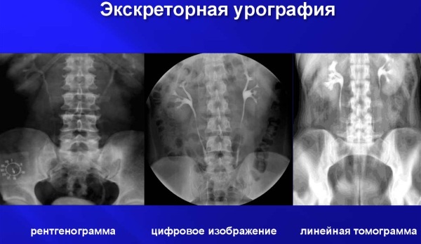 Экскреторная урография. Подготовка пациента, как проводится, противопоказания