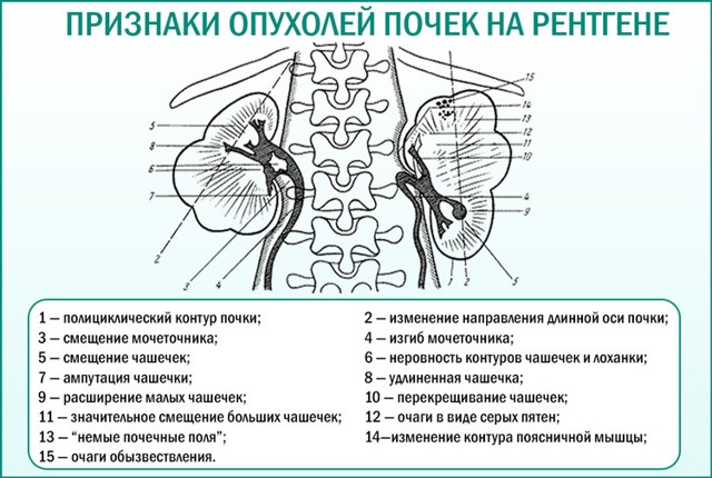 Экскреторная урография. Подготовка пациента, как проводится, противопоказания