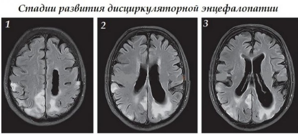 Энцефалопатия неуточненная. Что это такое у детей, грудничка, взрослых, симптомы, последствия