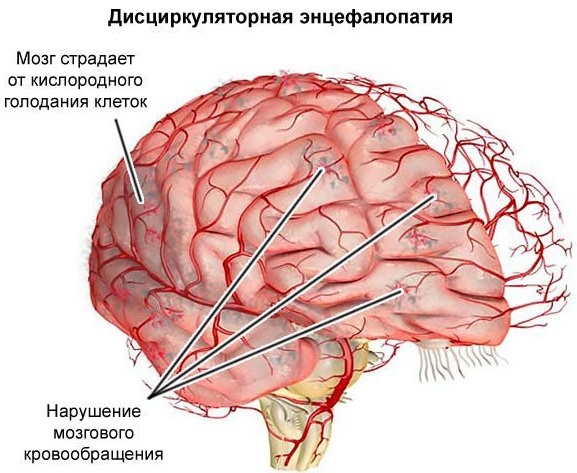 Энцефалопатия неуточненная. Что это такое у детей, грудничка, взрослых, симптомы, последствия