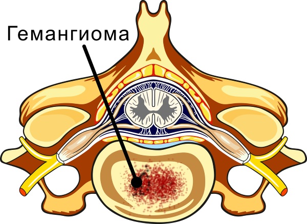 Гемангиома позвоночника что лучше мрт или кт