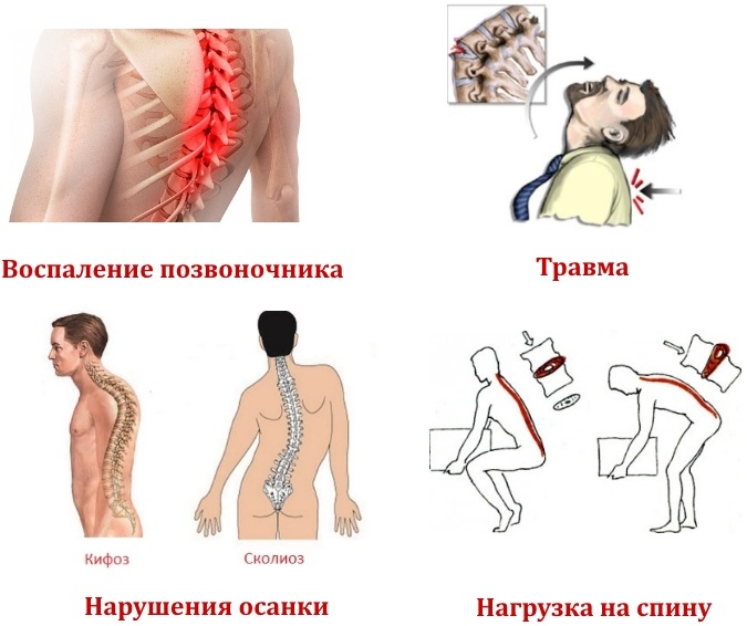 Гемангиолипома позвоночника. Что это такое, чем опасна, лечение народными средствами, лекарствами грудного, шейного, поясничного отдела