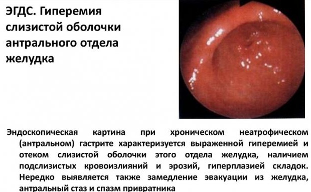 Гиперемирована слизистая. Что это значит умеренно, очагово, диффузно у взрослого, ребенка, лечение