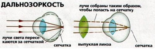 Гиперметропия (дальнозоркость) слабой степени у ребенка, средней, тяжелой. Причины, лечение