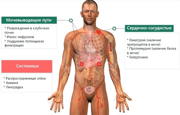 Гломерулонефрит. Симптомы и лечение у взрослых, детей, что это, рекомендации