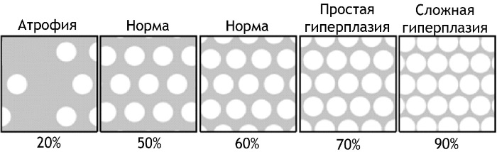 ГПЭ в гинекологии. Что это такое, симптомы, лечение гормонами, народными средствами, причины, последствия