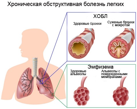 ХОБЛ (хроническая обструктивная болезнь легких). Лечение народными средствами в домашних условиях, симптомы, клинические рекомендации