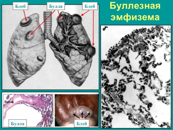 ХОБЛ (хроническая обструктивная болезнь легких). Лечение народными средствами в домашних условиях, симптомы, клинические рекомендации