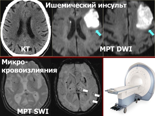 Карта вызова смп транзиторная ишемическая атака