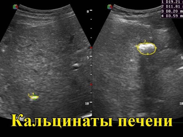 Кальцинаты в печени. Что это, причины, как лечить множественные, единичные у новорожденного, плода, взрослого