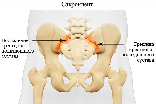 Крестцово-подвздошный сустав. Анатомия, воспаление, вывих, лечение