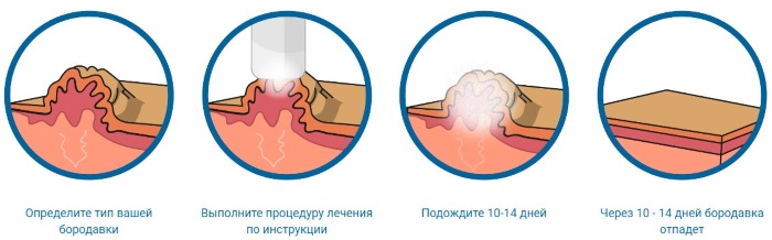 КриоФарма. Инструкция по применению от папиллом, бородавок, мозолей, цена