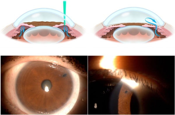 Лазерная иридэктомия. Что это такое, показания, послеоперационный период, ограничения, цена
