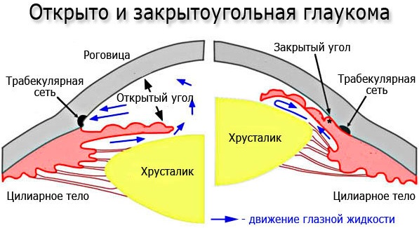 Лазерная иридэктомия. Что это такое, показания, послеоперационный период, ограничения, цена