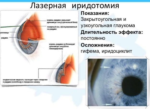 Лазерная иридэктомия. Что это такое, показания, послеоперационный период, ограничения, цена