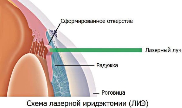 Лазерная иридэктомия. Что это такое, показания, послеоперационный период, ограничения, цена