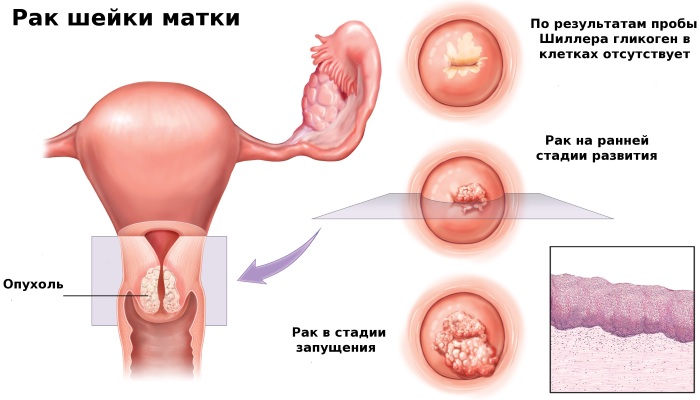 Миома матки. Чем опасна во время беременности, менопаузы