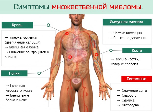 Миеломная болезнь (множественная миелома). Что это у взрослых, детей, рекомендации, лечение, диагностика, прогноз