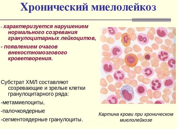 Миелоциты в анализе крови. Что это у ребенка, взрослого, норма, повышены, расшифровка