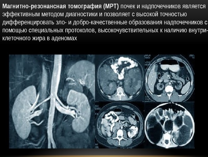 МРТ почек и мочевыводящих путей. Цена, что показывает, как делается, подготовка