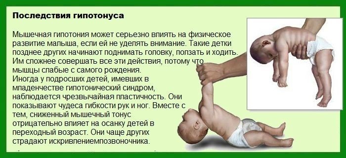 Мышечная дистония у грудничка, детей, взрослых. Что это такое, симптомы, лечение