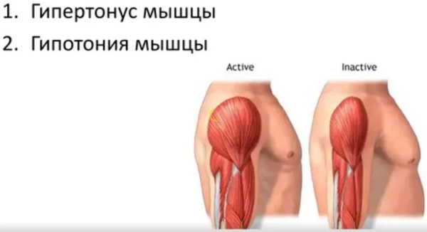 Мышечная дистония у грудничка, детей, взрослых. Что это такое, симптомы, лечение